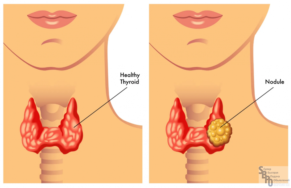 Многоузловой зоб щитовидки. Узловой гипертиреоидный зоб. Щитовидная железа зоб узлы. Многоузловой эутиреоидный зоб щитовидной железы.