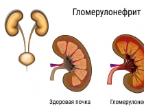 Лечение пиелонефрита