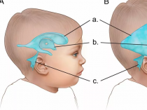Гидроцефалия головного мозга
